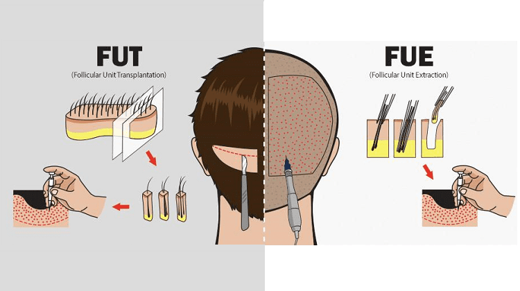 Μεταμόσχευση Μαλλιών: Οι Τεχνικές Της Επέμβασης, Μύθοι Και Αλήθειες