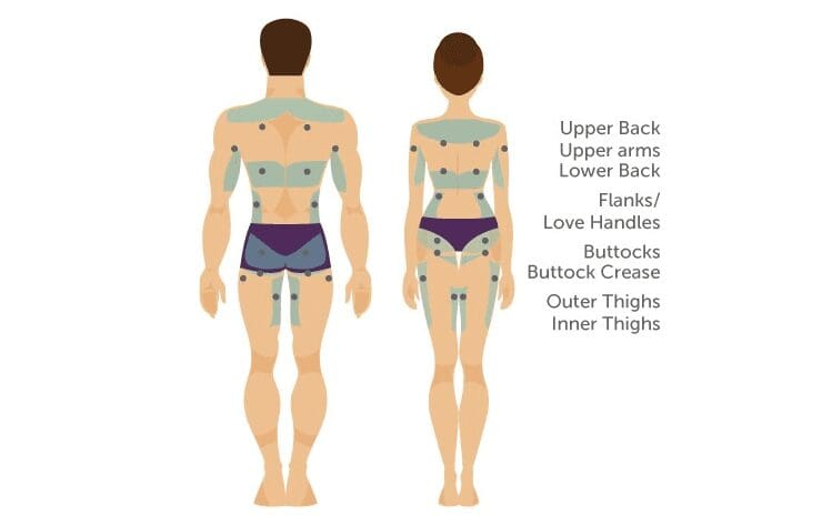 Λιποαναρρόφηση 4